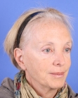Before Hair Transplant&nbsp;Hair Thinning